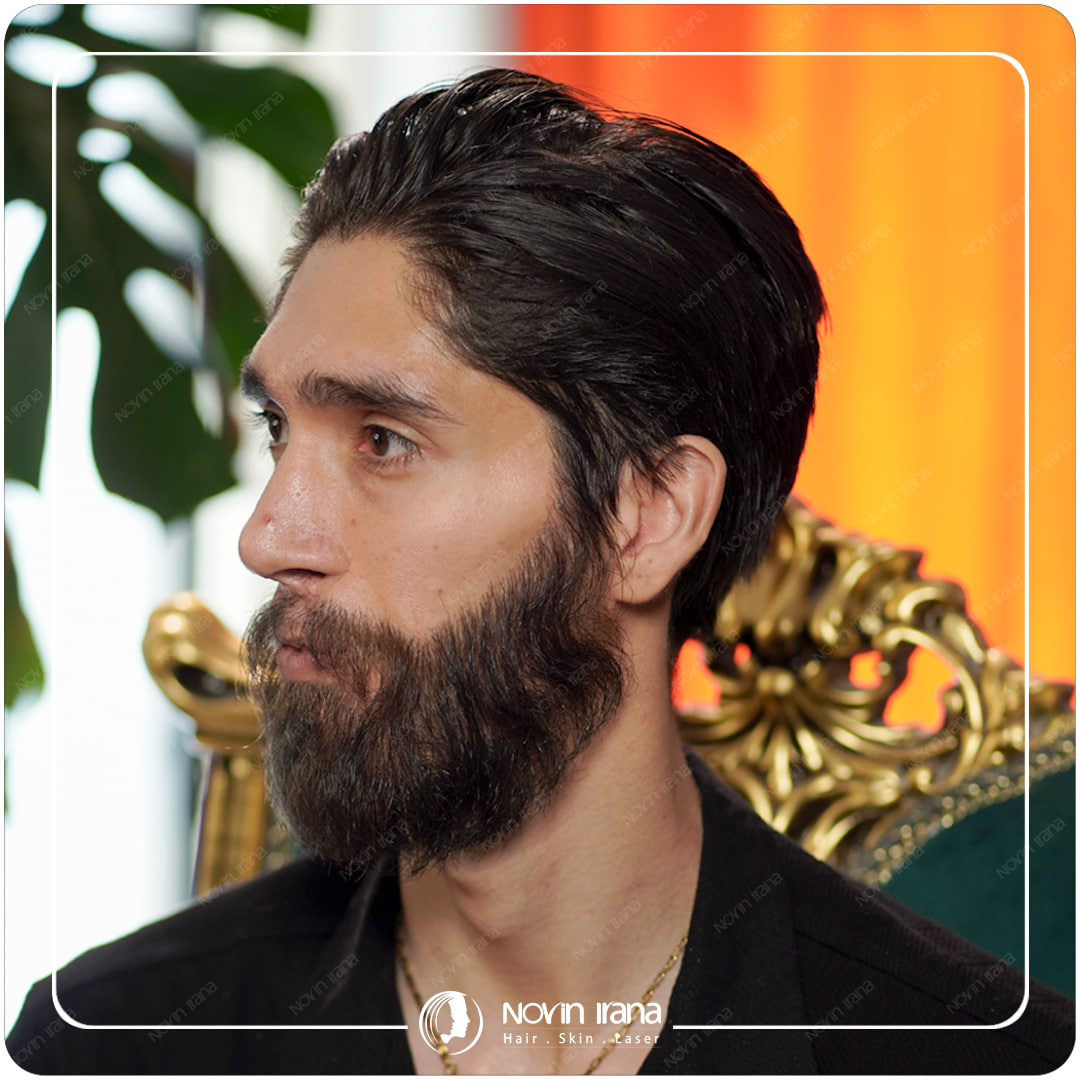 زراعة الشعر