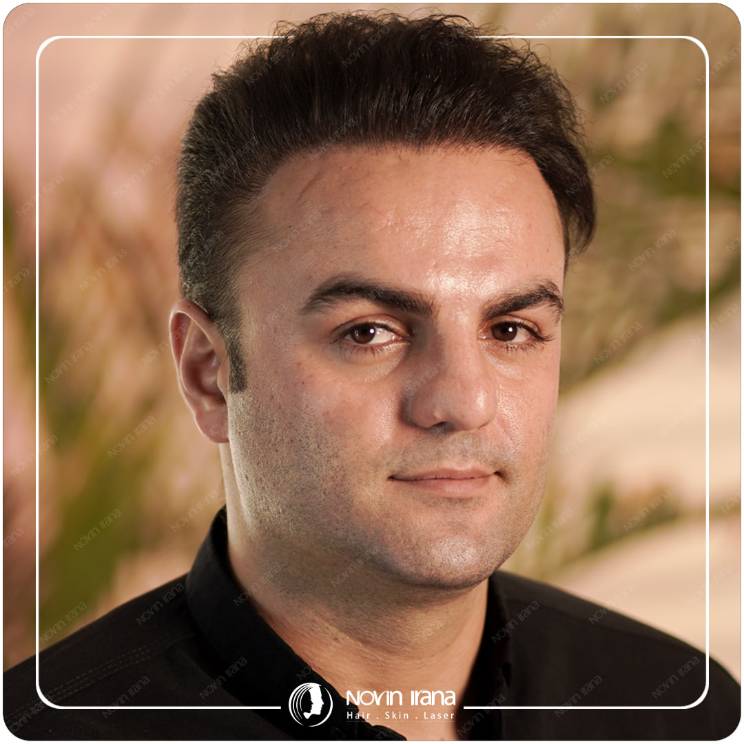 زراعة الشعر