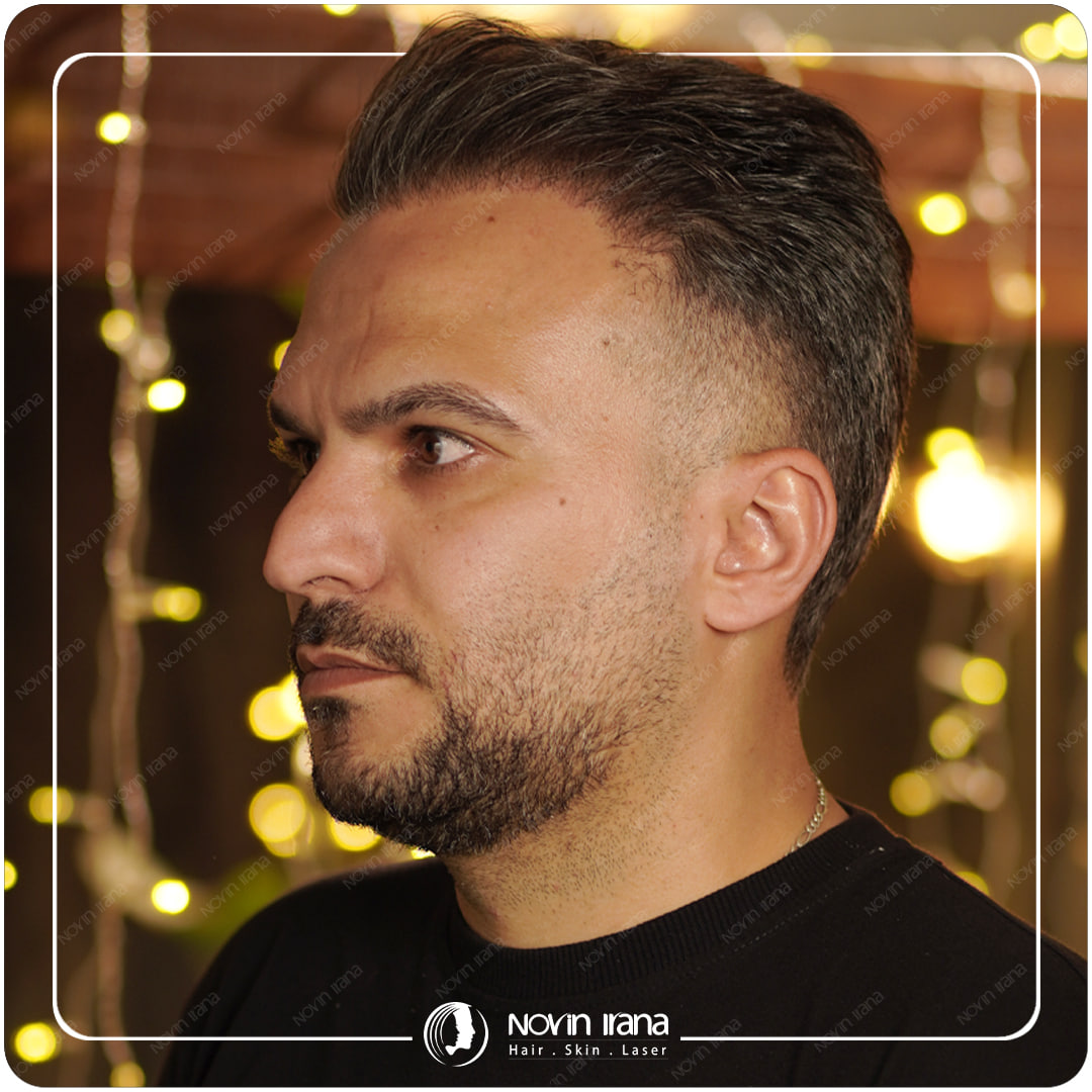 Hair Transplant