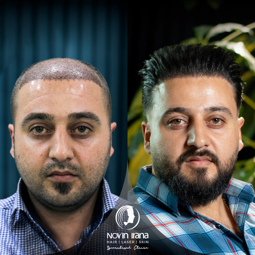 Hair Transplant