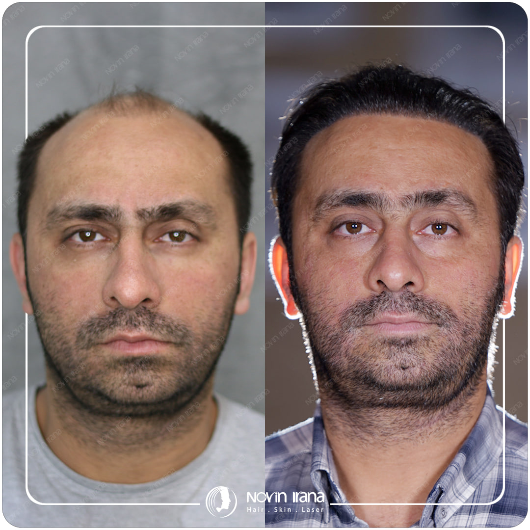 Hair Transplant