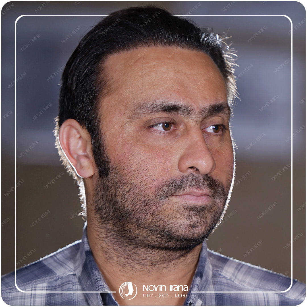 زراعة الشعر