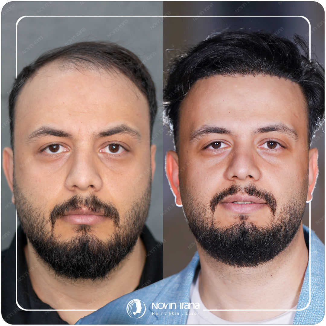 زراعة الشعر