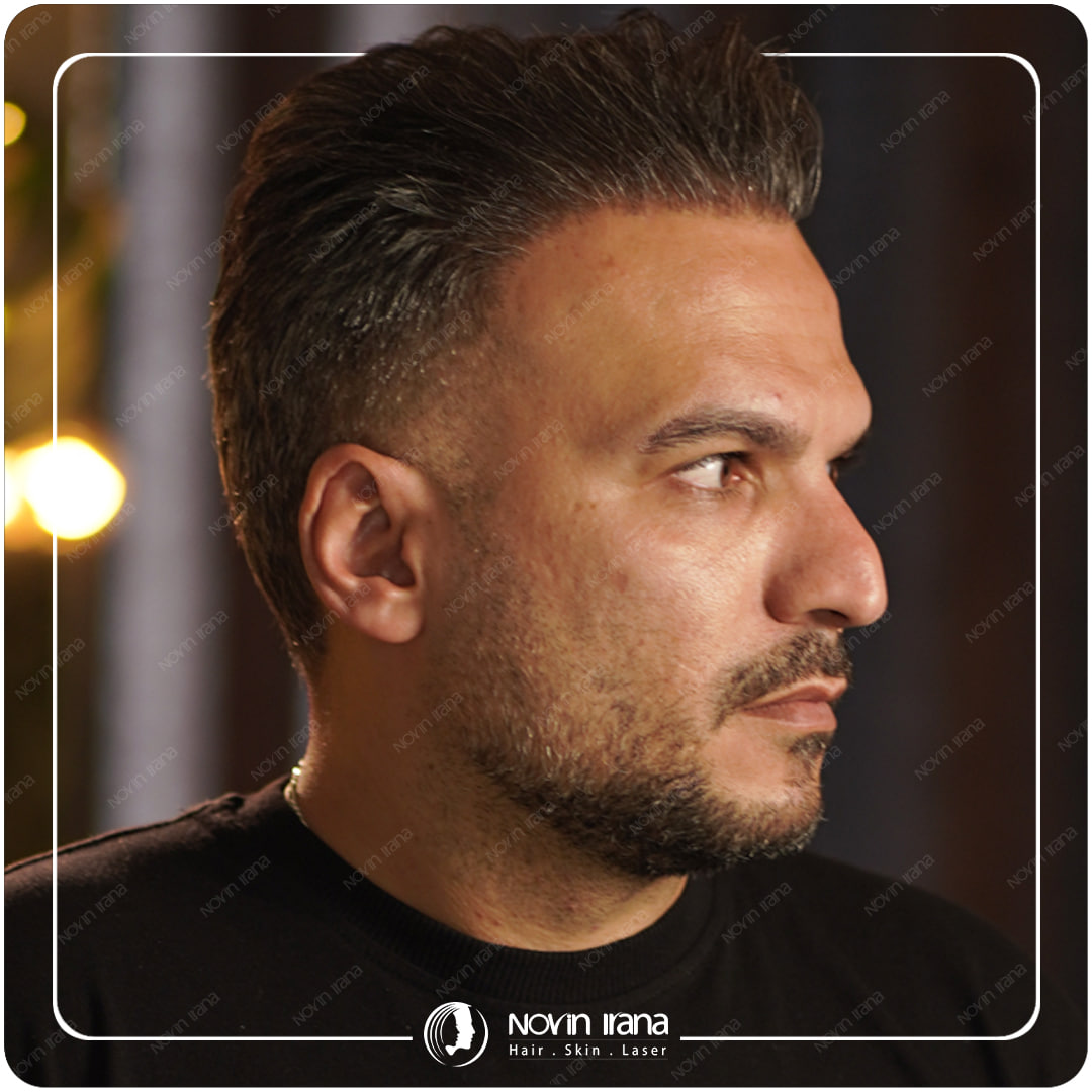 Hair Transplant