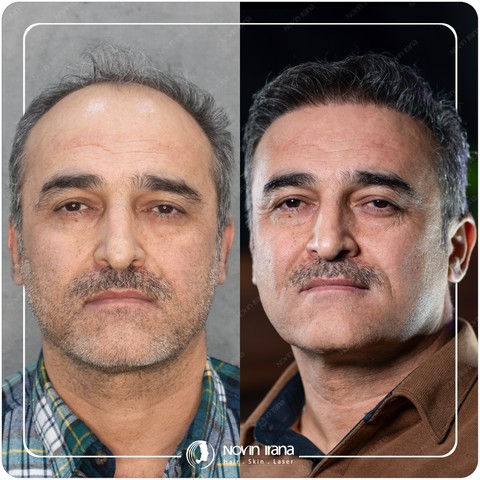 کاشت مو