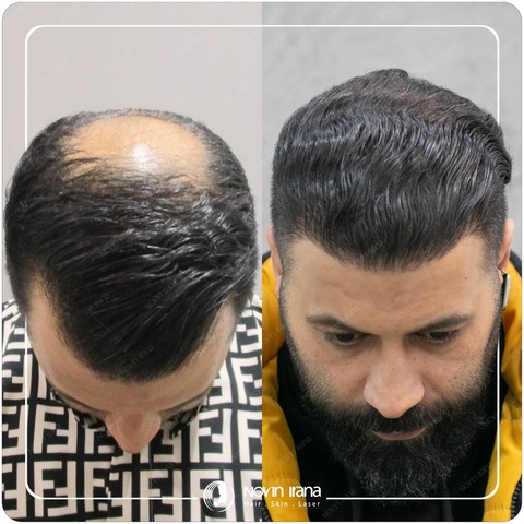 کاشت مو