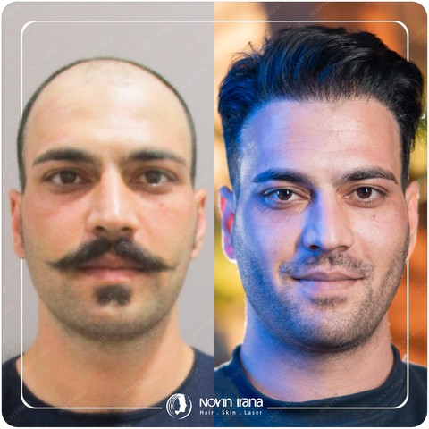 کاشت مو