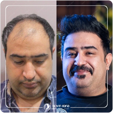 کاشت مو