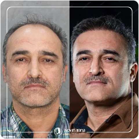 کاشت مو
