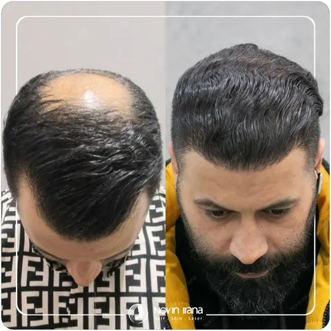 کاشت مو