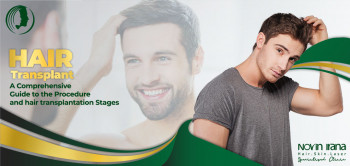 A Comprehensive Guide to the Procedure and hair transplantation Stages