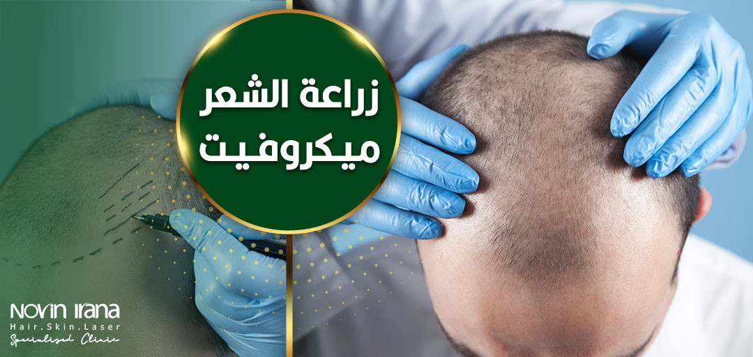 زراعة الشعر ميكروفيت