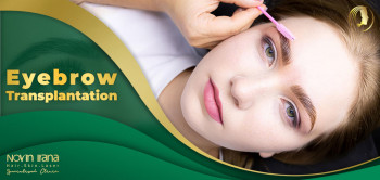 Eyebrow Transplantation