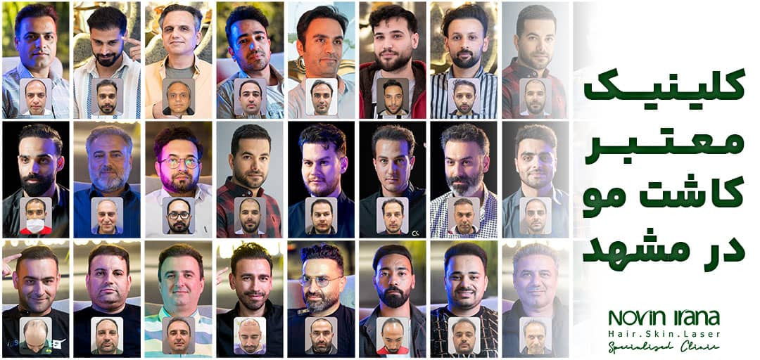 کلینیک معتبر کاشت مو در مشهد