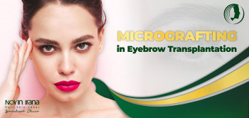 Micrografting in Eyebrow Transplantation