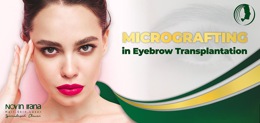 Micrografting in Eyebrow Transplantation