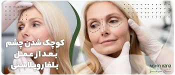 کوچک شدن چشم بعد از عمل بلفاروپلاستی