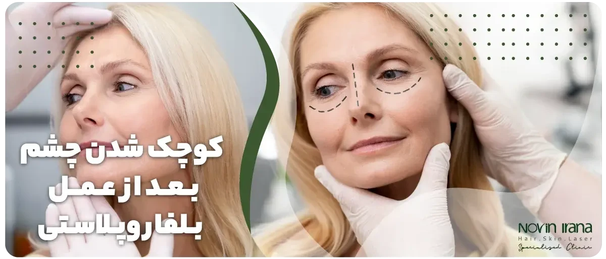 کوچک شدن چشم بعد از عمل بلفاروپلاستی