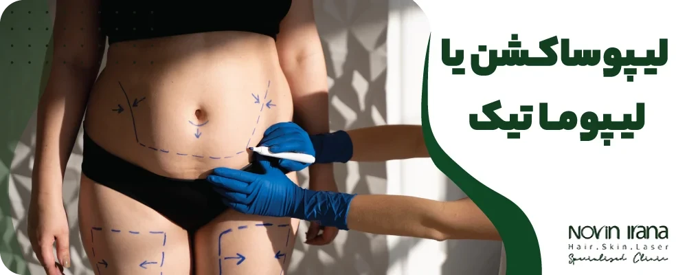 لیپوساکشن یا لیپوماتیک