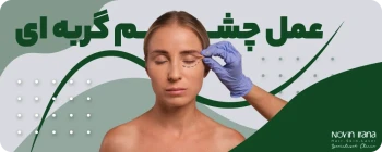 عمل چشم گربه ای
