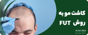 کاشت مو به روش fut