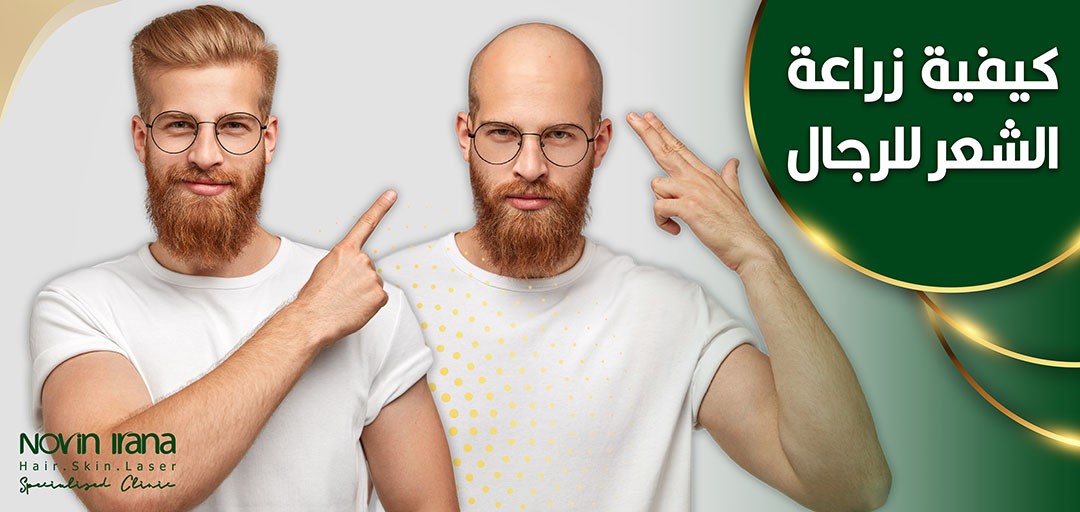 كيفية زراعة الشعر للرجال