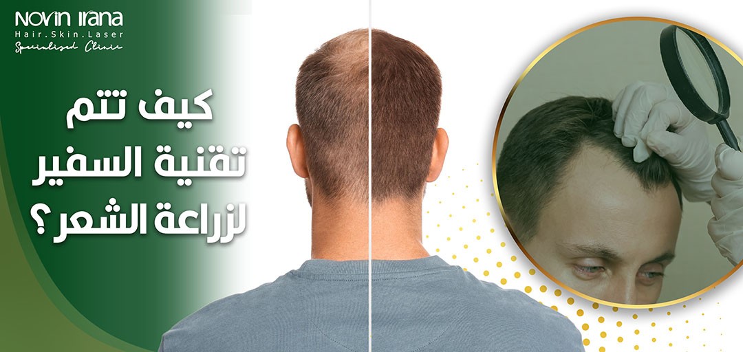 كيف تتم تقنية السفير لزراعة الشعر