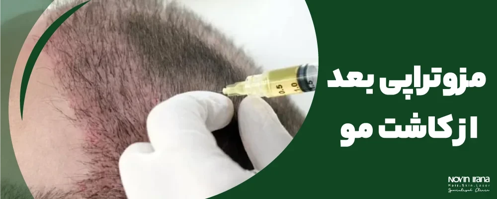 مزوتراپی بعد از کاشت مو