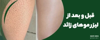 قبل و بعد از لیزر موهای زائد