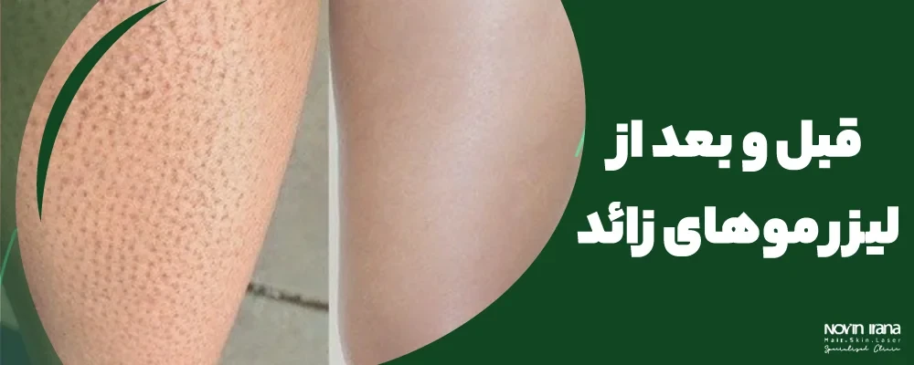 قبل و بعد از لیزر موهای زائد
