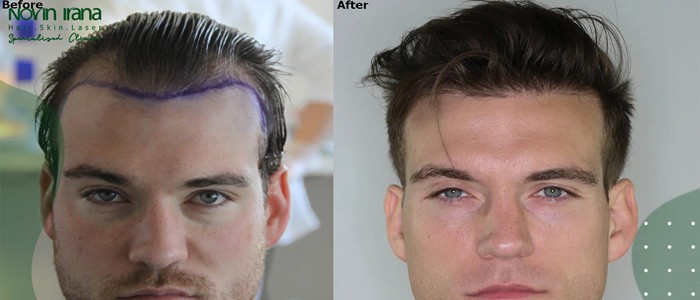 العناية بعد زراعة الشعر