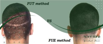 الفرق بين زراعة الشعر FUE و FUT