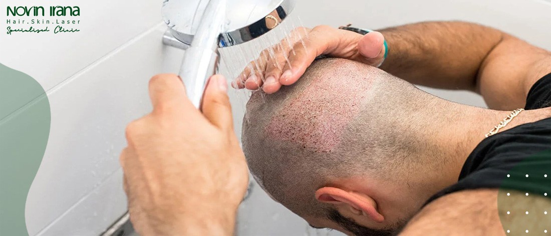 الغسل مباشرة بعد زراعة الشعر