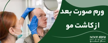 ورم صورت بعد از کاشت مو