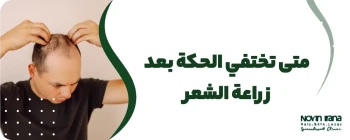 متى تختفي الحكة بعد زراعة الشعر