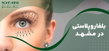 بهترین دکتر بلفاروپلاستی در مشهد