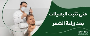 متى تثبت البصيلات بعد زراعة الشعر