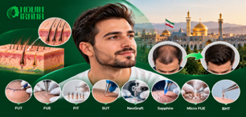 کاشت مو چیست؟ انواع روش های کاشت مو