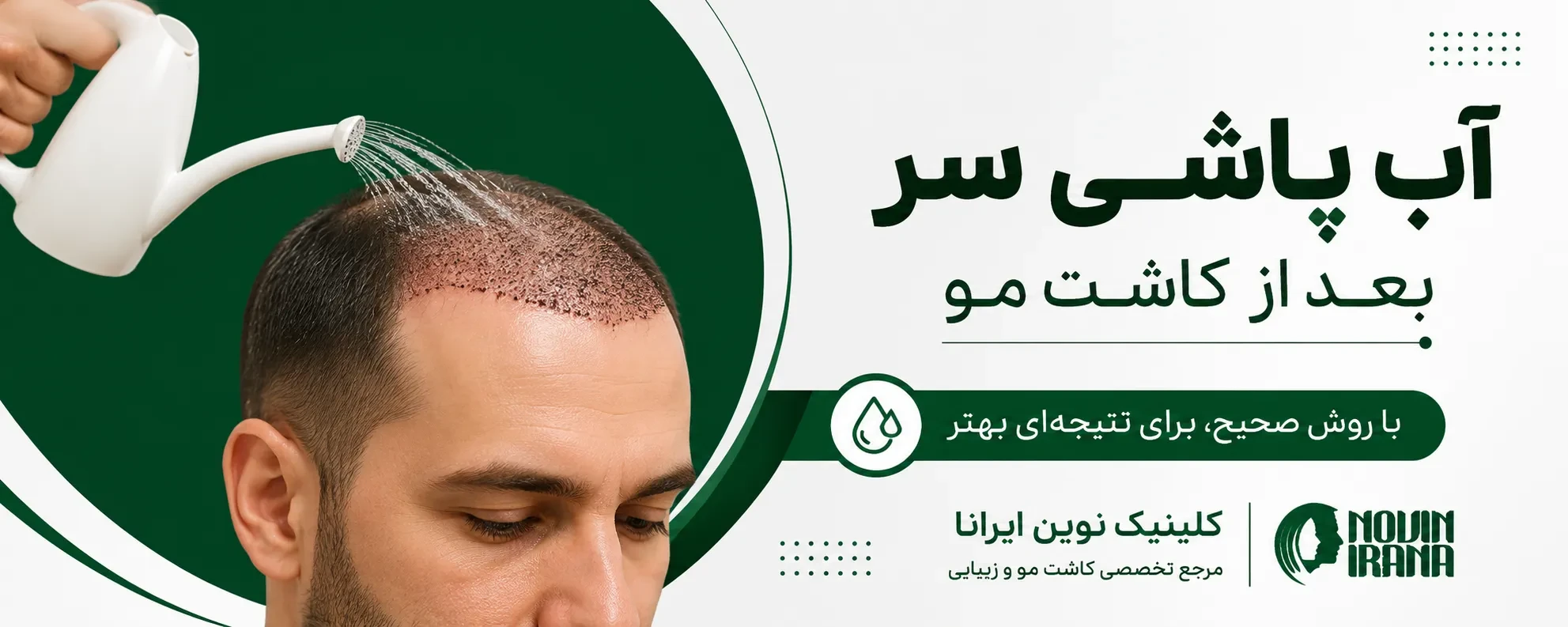 آب پاشی سر بعد از کاشت مو