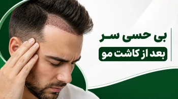 بی حسی سر بعد از کاشت مو