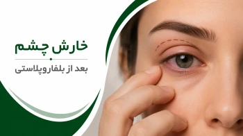 خارش چشم بعد از بلفاروپلاستی