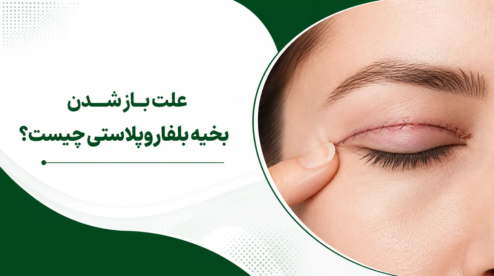 باز شدن بخیه بلفاروپلاستی