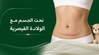 نحت الجسم مع الولادة القيصرية