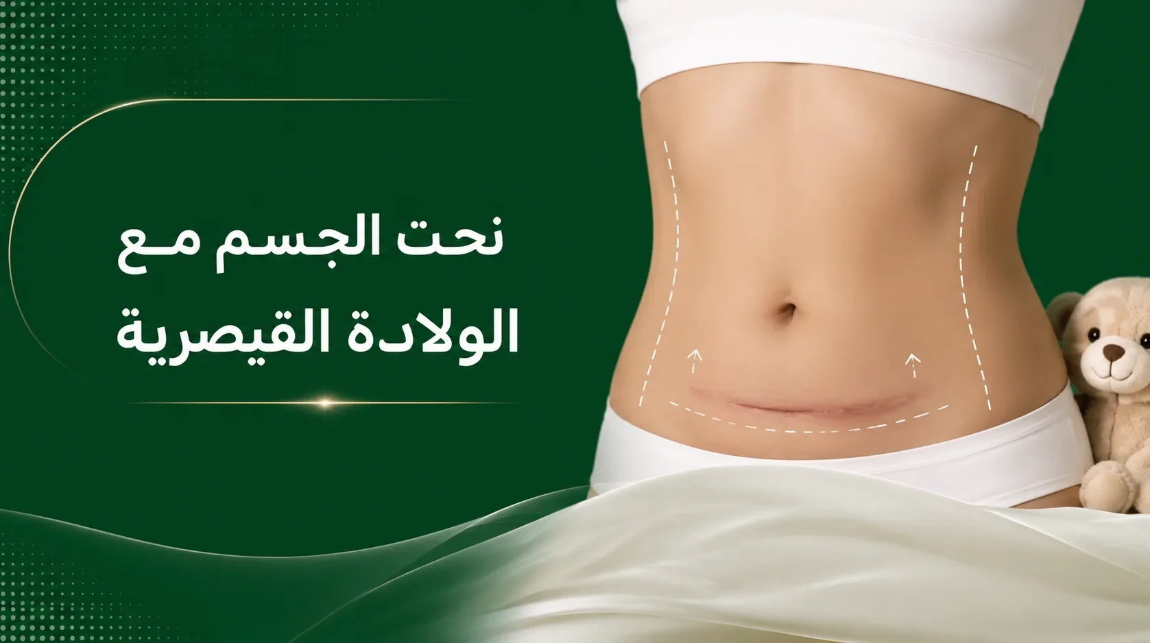 نحت الجسم مع الولادة القيصرية