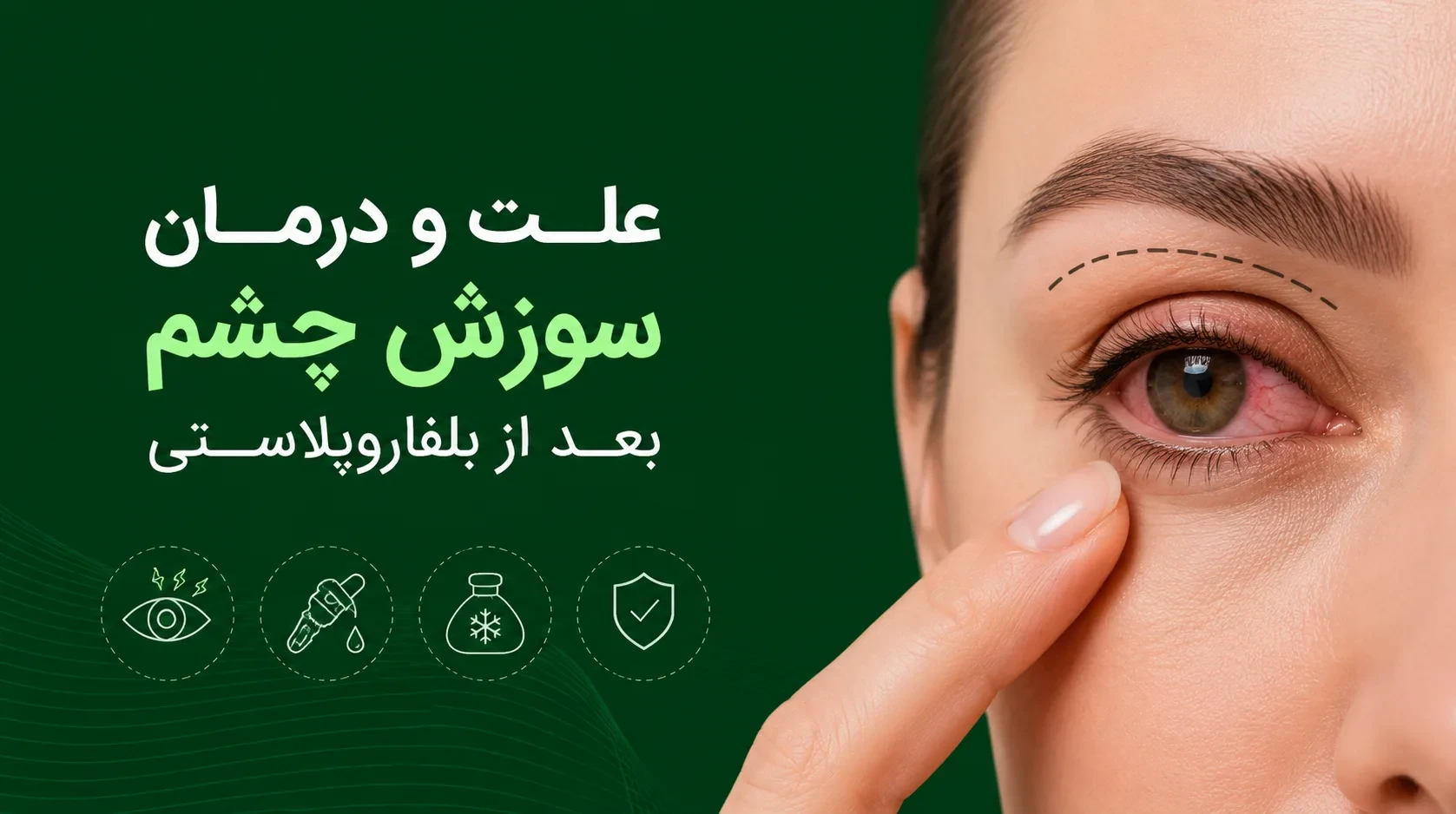 سوزش چشم بعد از بلفاروپلاستی
