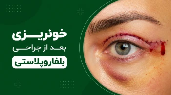 خونریزی بعد از بلفاروپلاستی