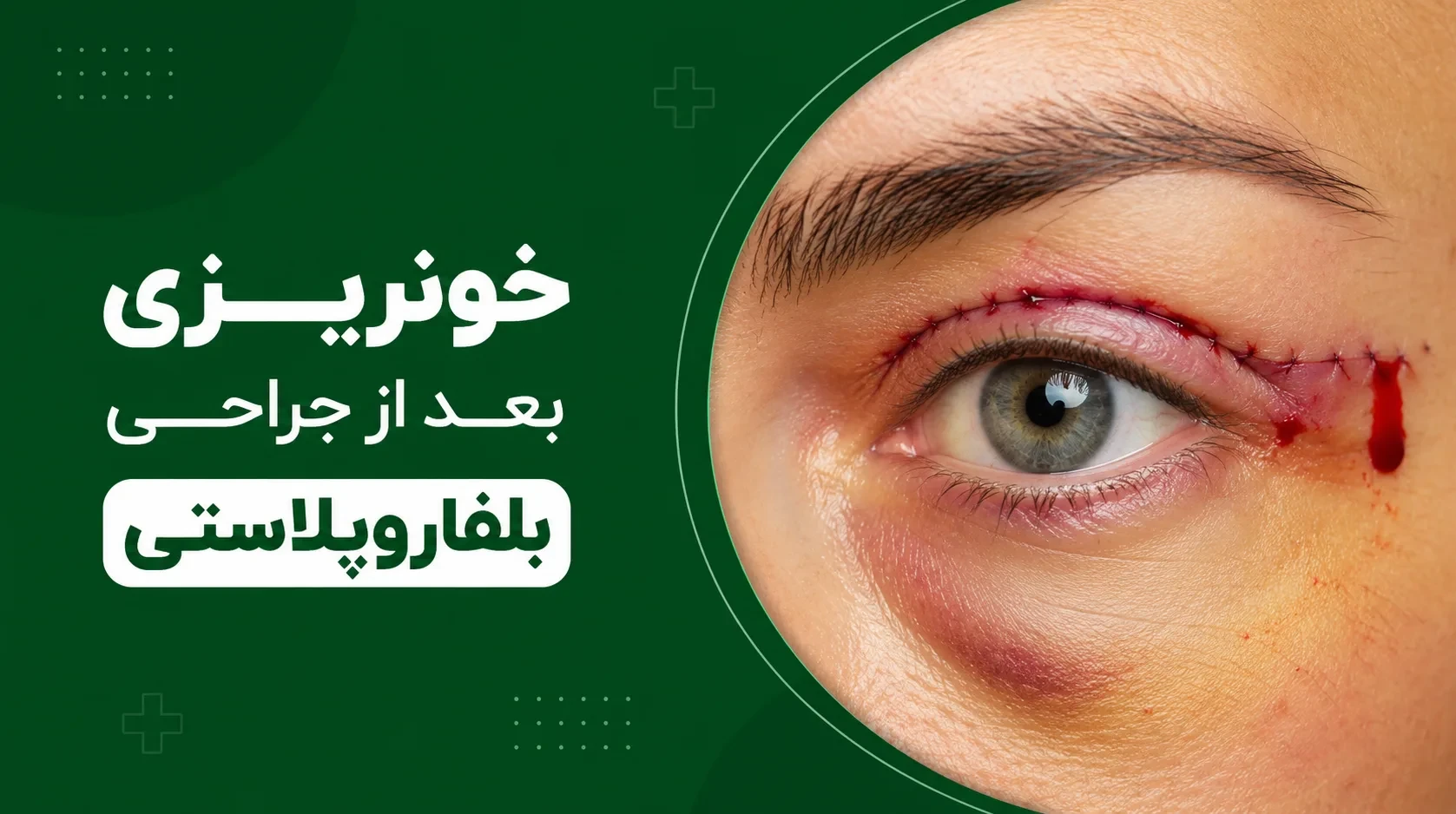خونریزی بعد از بلفاروپلاستی