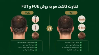 تفاوت کاشت مو به روش FUE و FUT