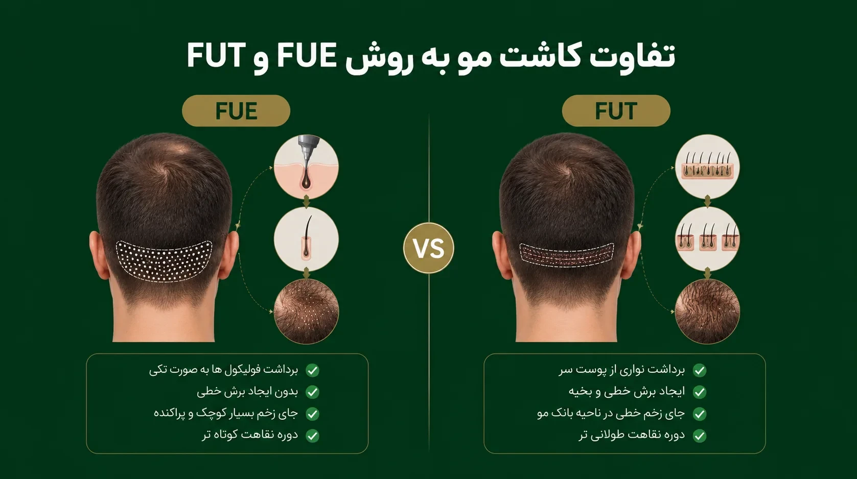 تفاوت کاشت مو به روش FUE و FUT