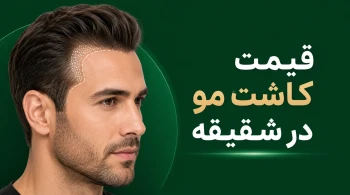 قیمت کاشت مو در شقیقه